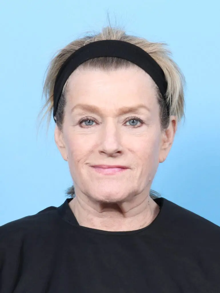 Eyelid Surgery - Case 52328 - After