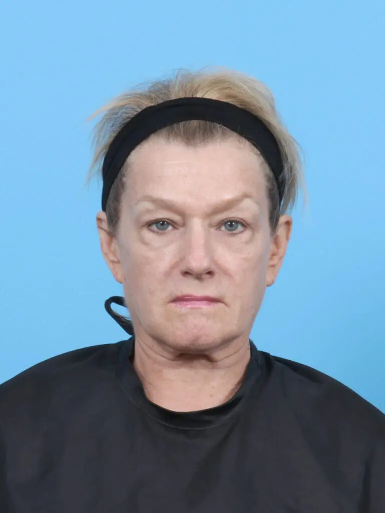 Eyelid Surgery - Case 52328 - Before