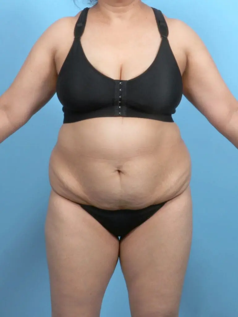 Tummy Tuck - Case 52352 - Before