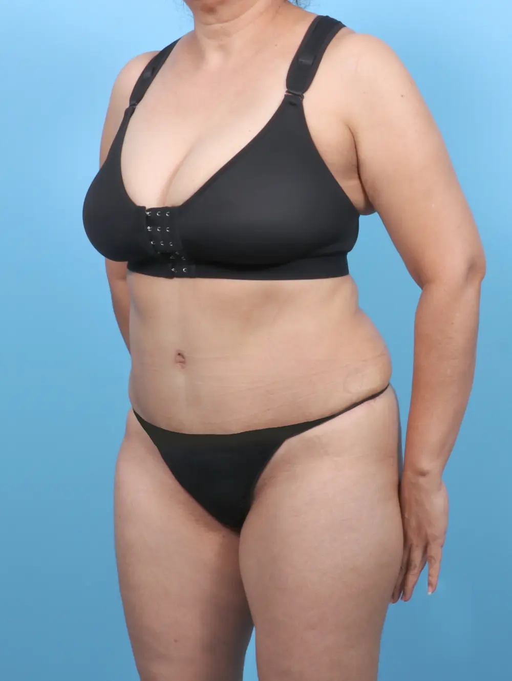 Tummy Tuck Patient Photo - Case 52352 - after view-1