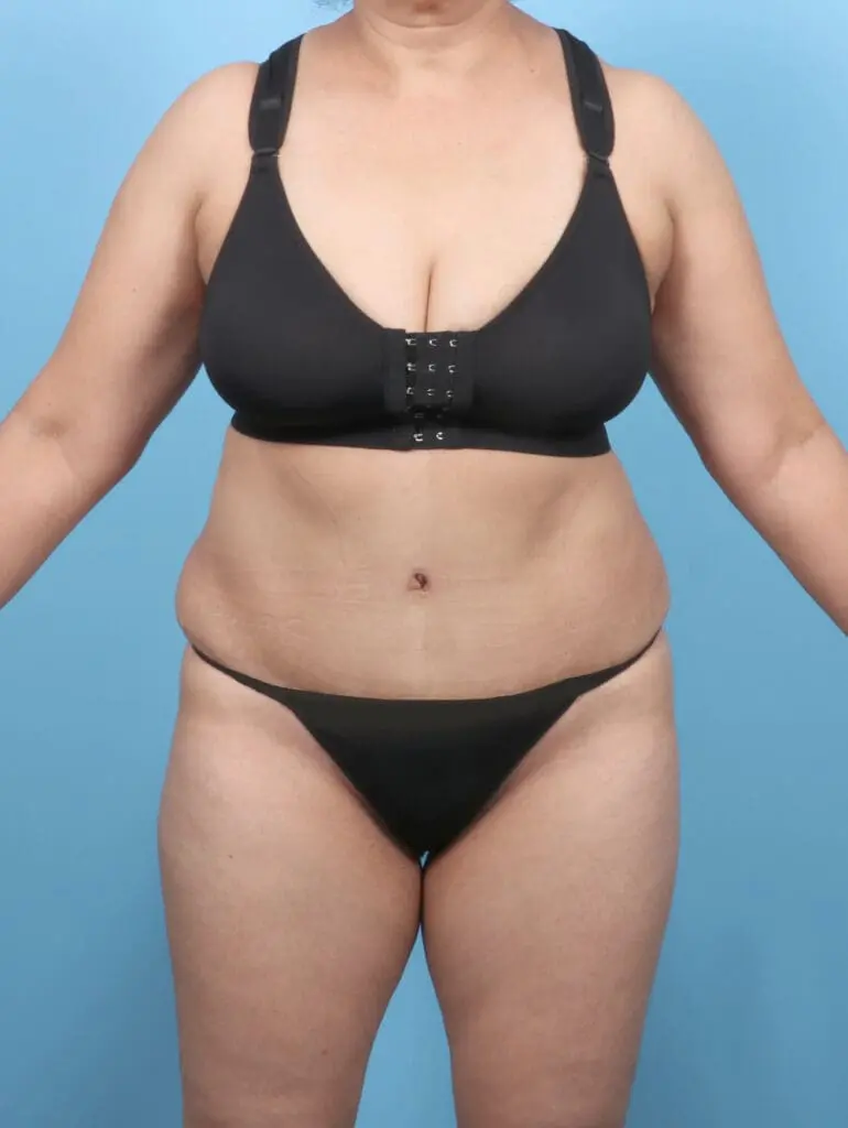 Tummy Tuck - Case 52352 - After