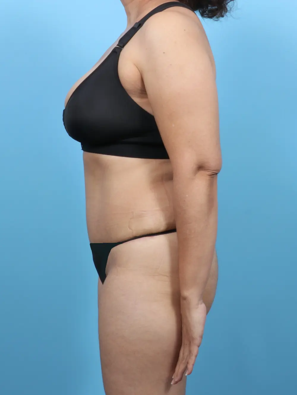 Tummy Tuck Patient Photo - Case 52352 - after view-2