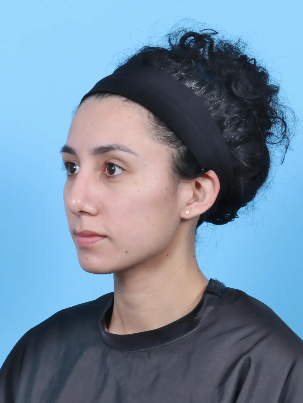 Rhinoplasty Patient Photo - Case 52360 - after view-1