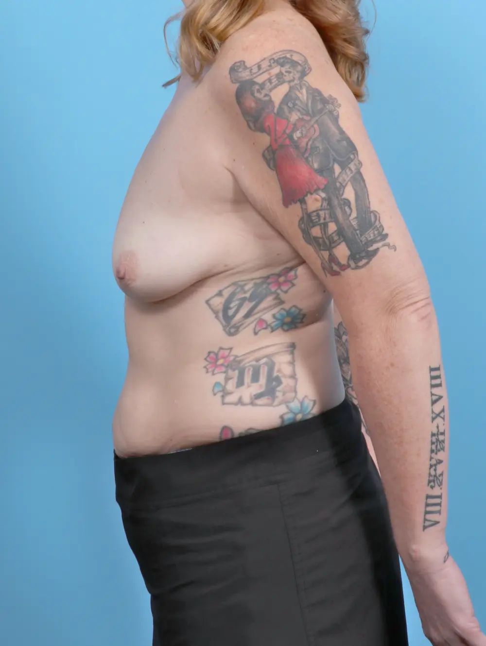 Breast Lift/Reduction with Implants Patient Photo - Case 52393 - before view-2