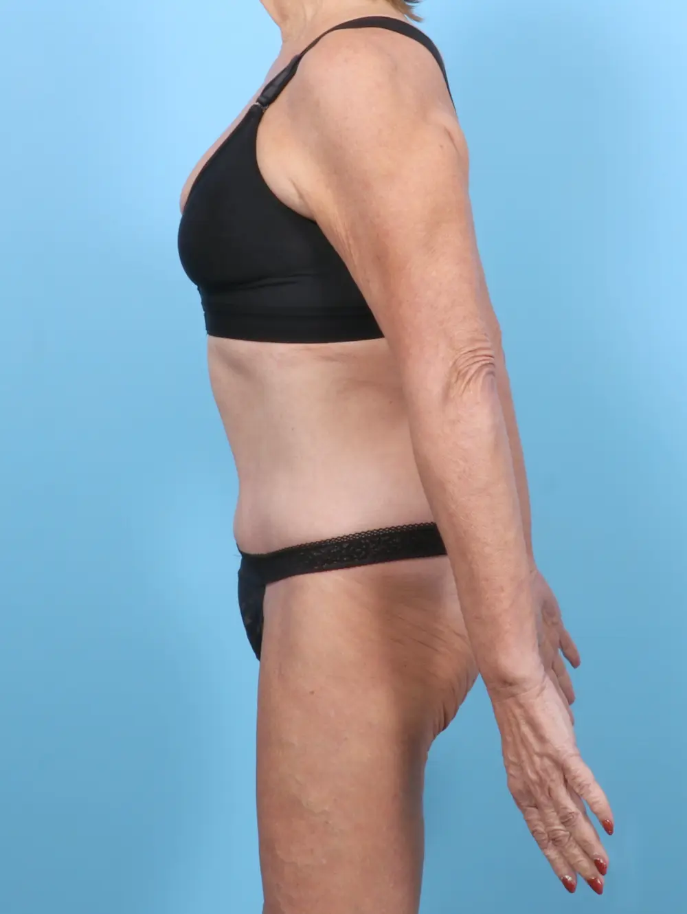 Tummy Tuck Patient Photo - Case 52418 - after view-2