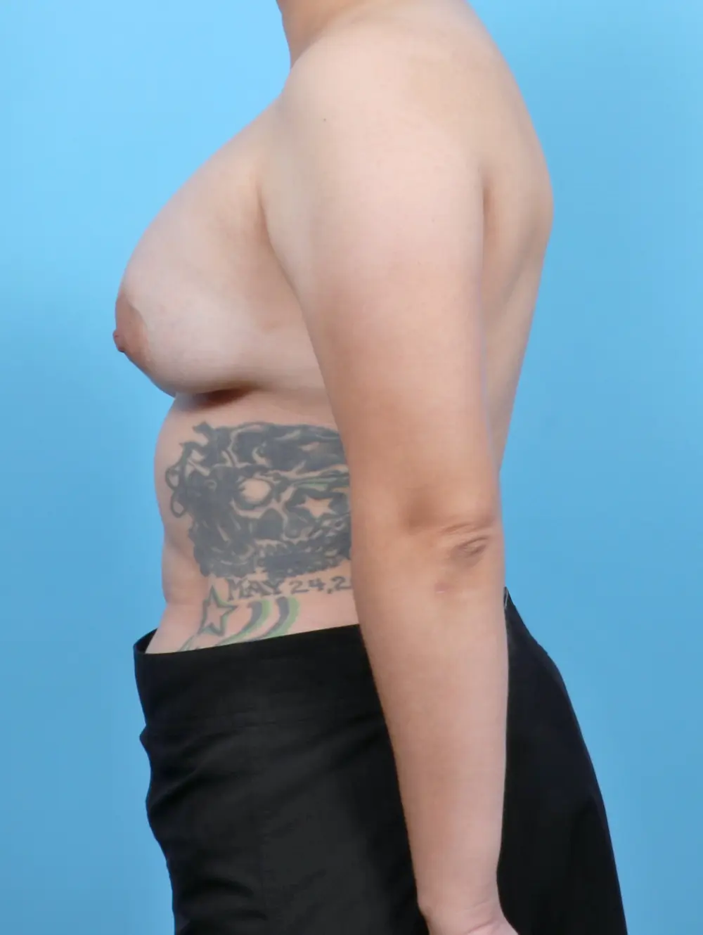 Breast Implant Revision Patient Photo - Case 52442 - before view-2