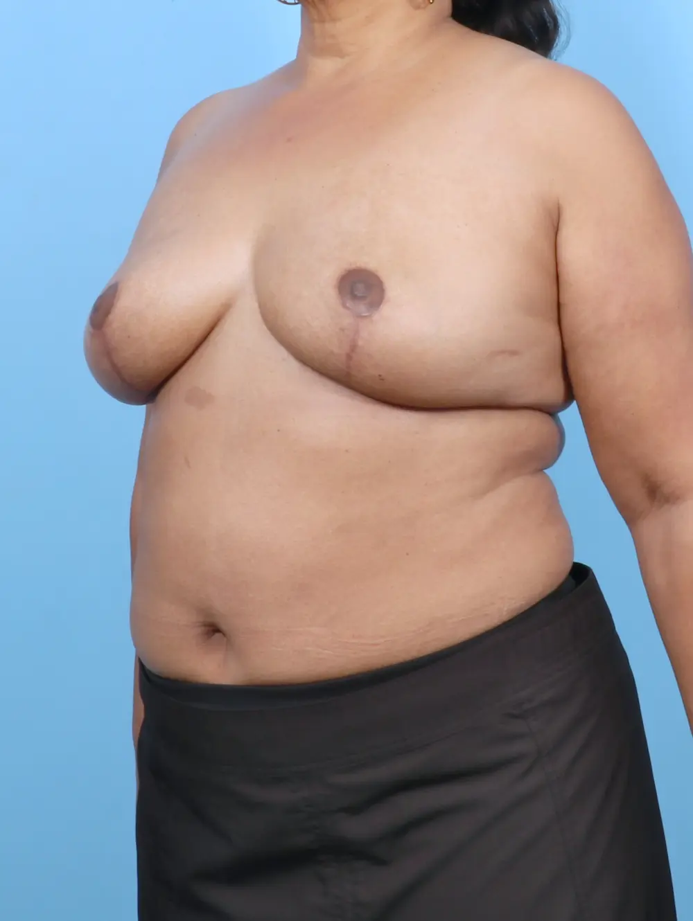 Breast Implant Removal Patient Photo - Case 52467 - after view-1