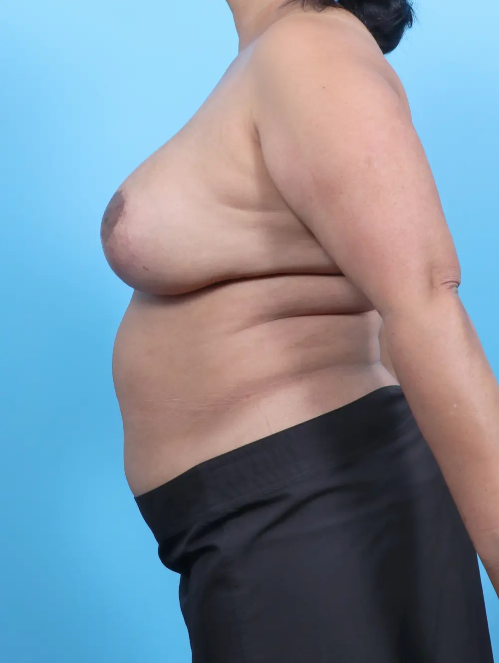 Breast Implant Removal Patient Photo - Case 52467 - before view-2