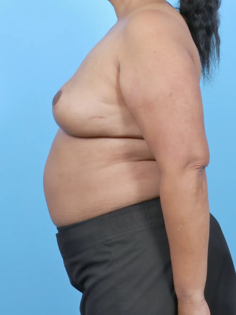 Breast Implant Removal Patient Photo - Case 52467 - after view-2