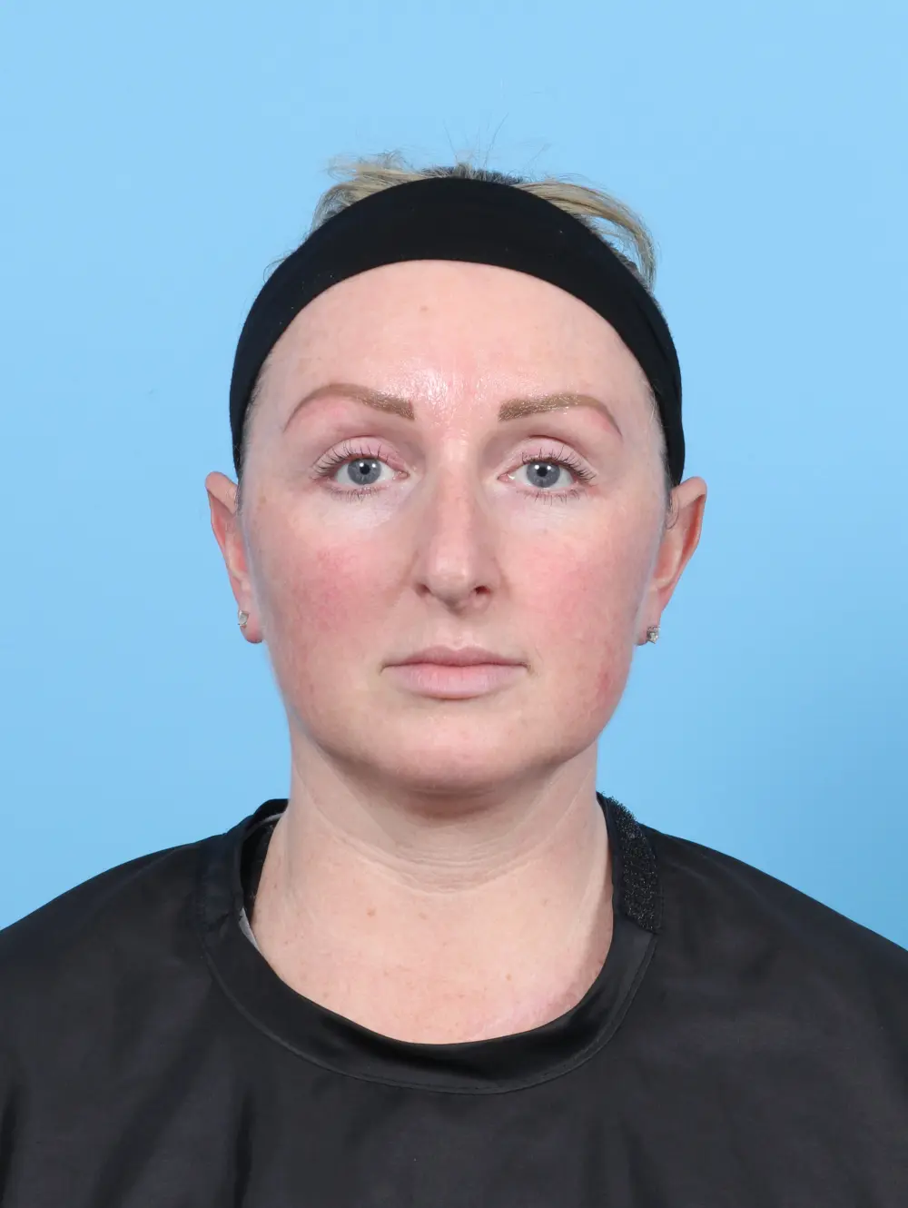 Rhinoplasty Patient Photo - Case 52475 - before view-2