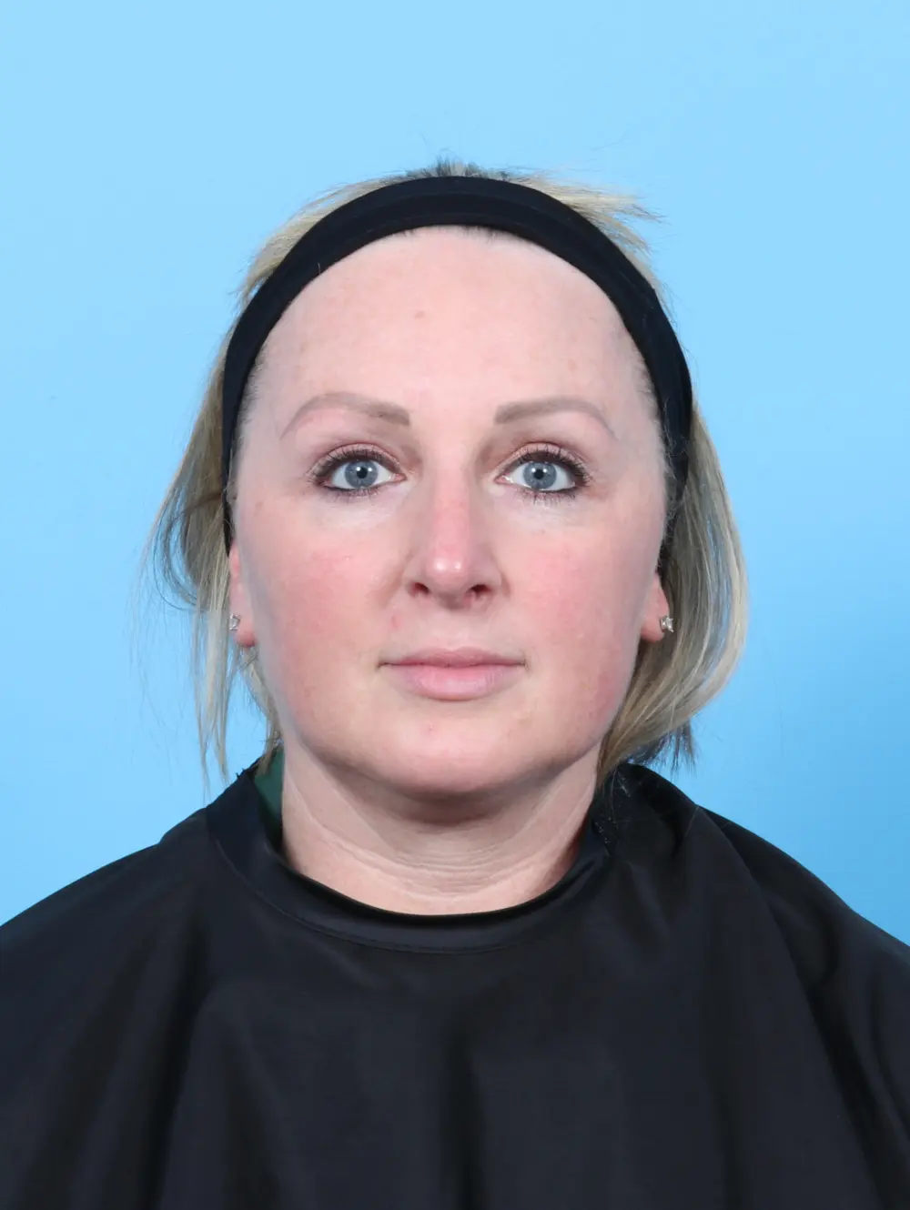 Rhinoplasty Patient Photo - Case 52475 - after view-2