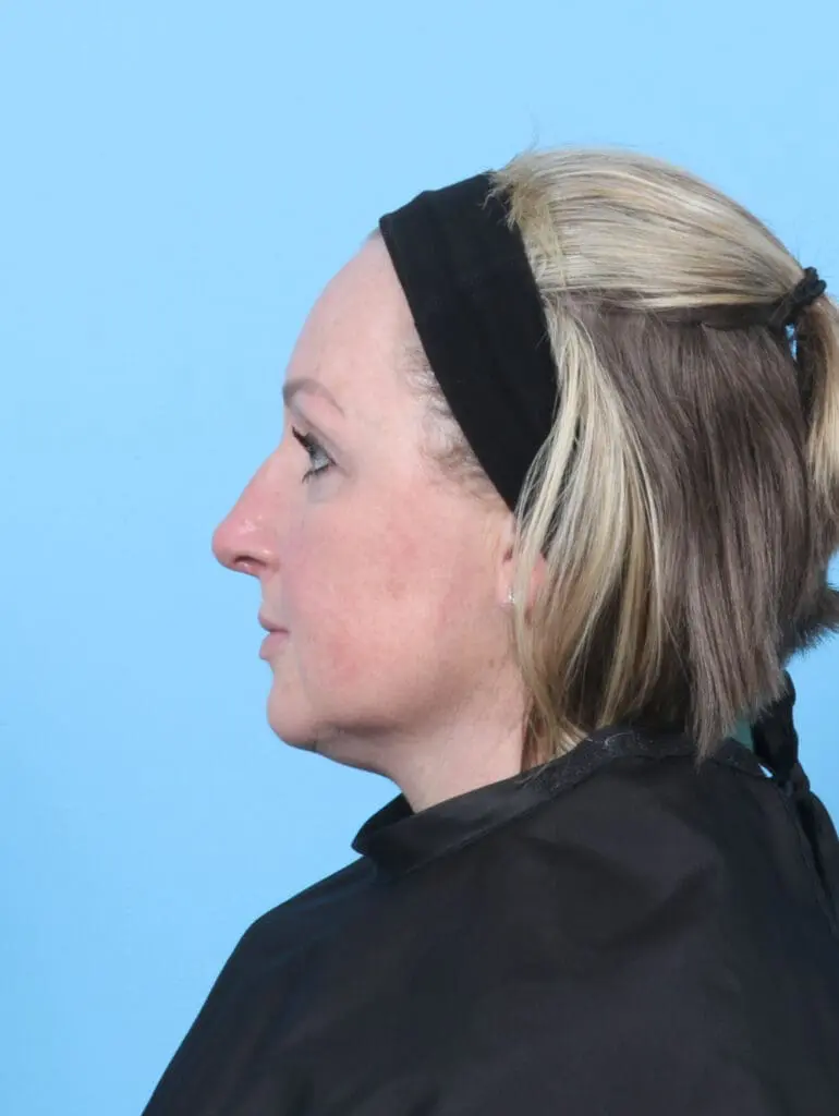 Rhinoplasty - Case 52475 - After