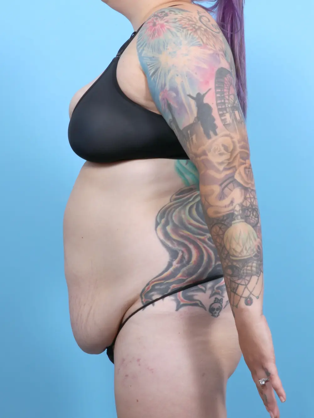 Tummy Tuck Patient Photo - Case 52483 - before view-2