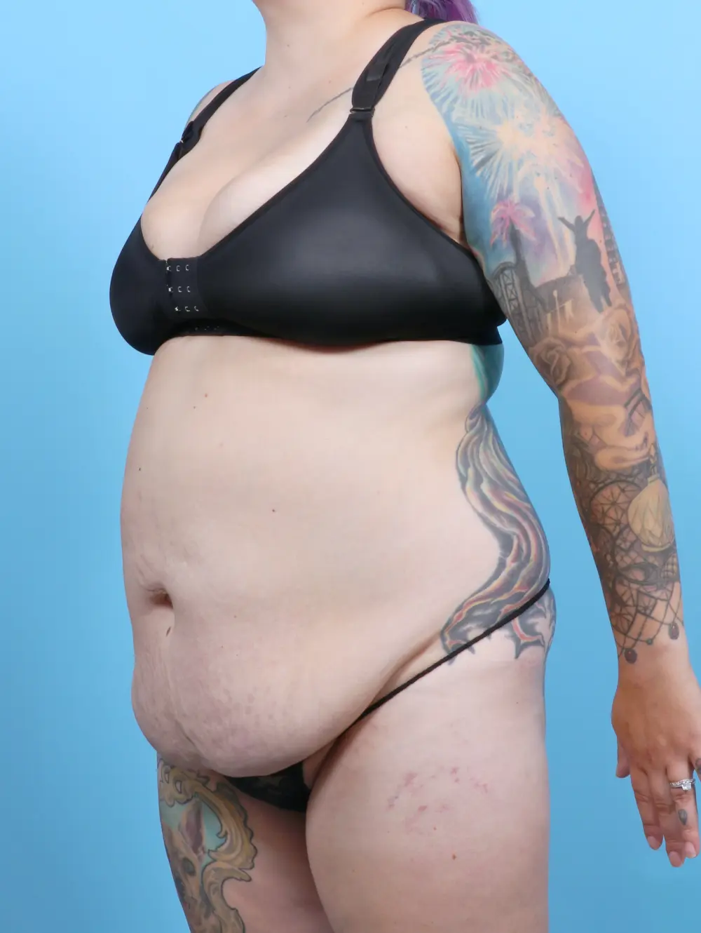 Tummy Tuck Patient Photo - Case 52483 - before view-1