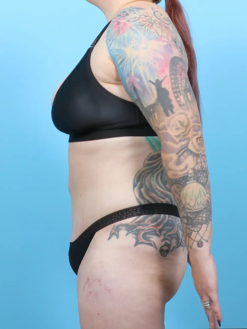 Tummy Tuck Patient Photo - Case 52483 - after view-2