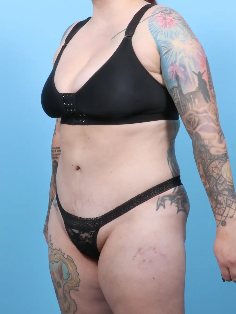 Tummy Tuck Patient Photo - Case 52483 - after view-1