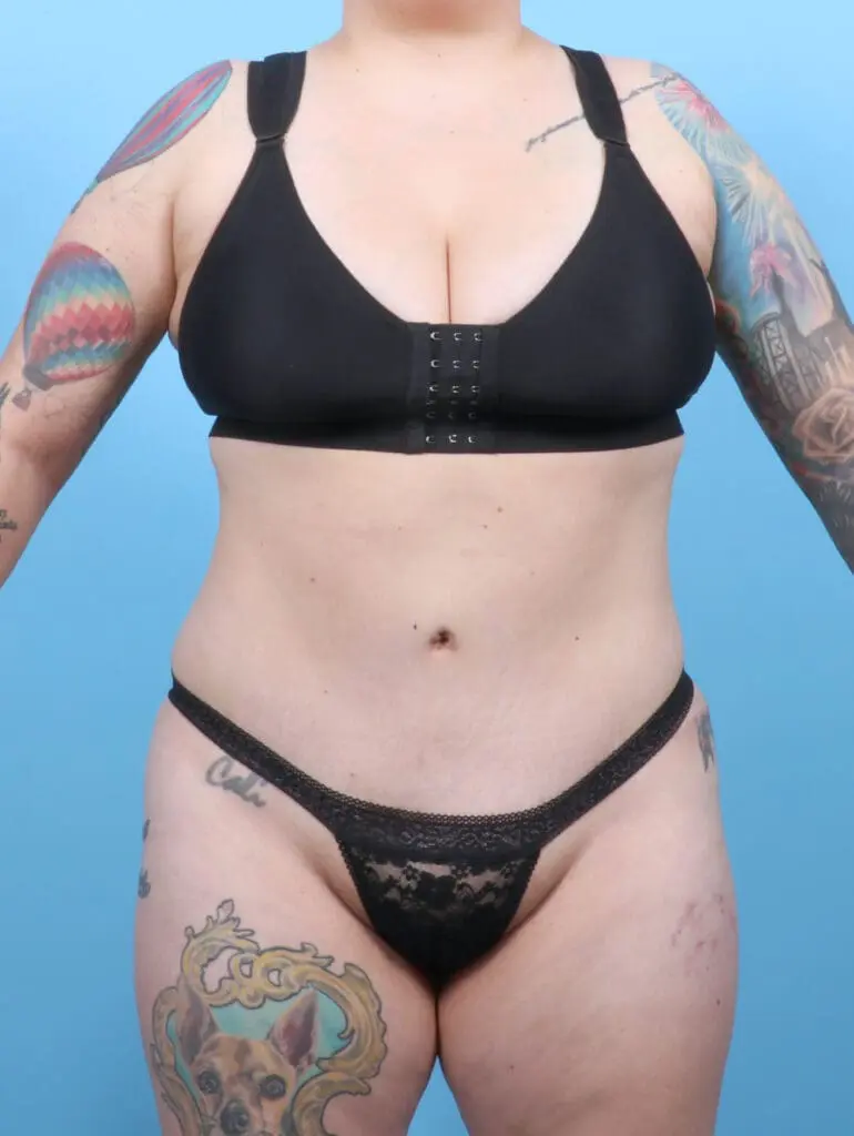 Tummy Tuck - Case 52483 - After