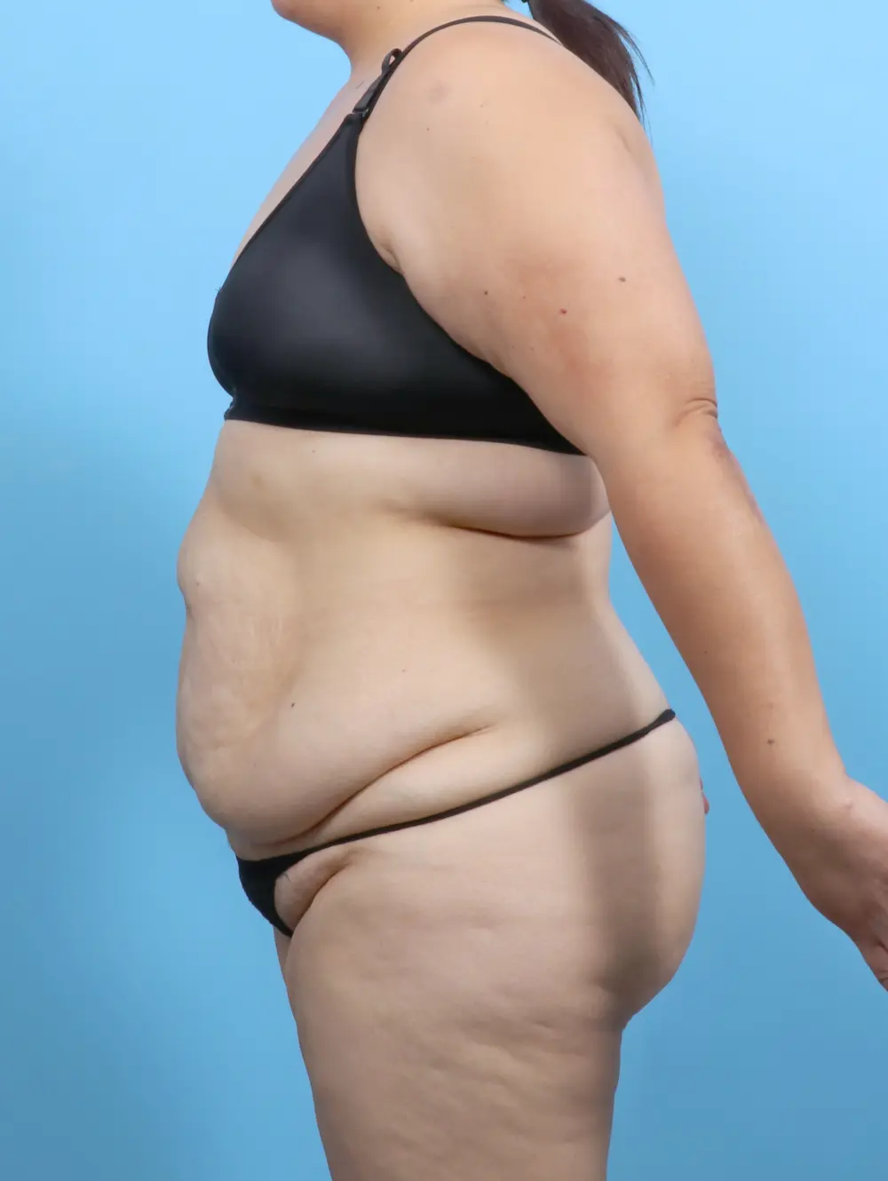 Tummy Tuck Patient Photo - Case 52493 - before view-2