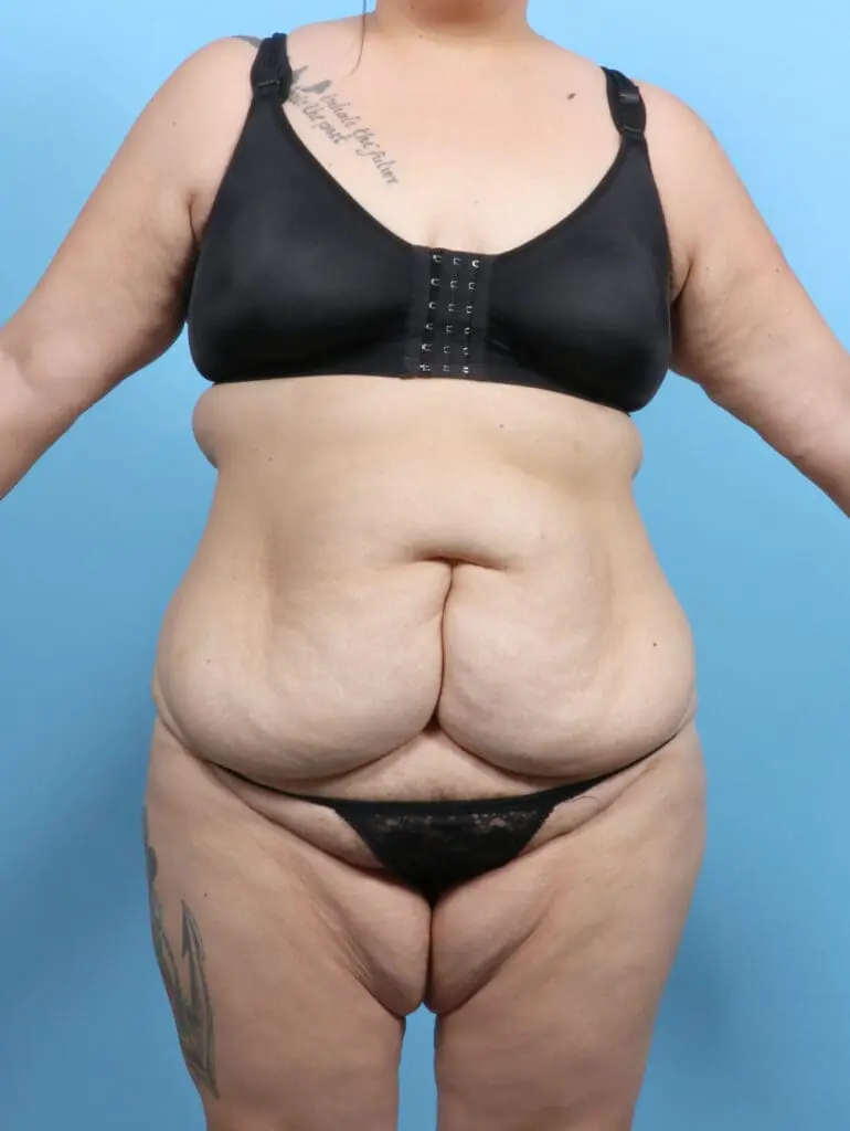 Tummy Tuck - Case 52493 - Before