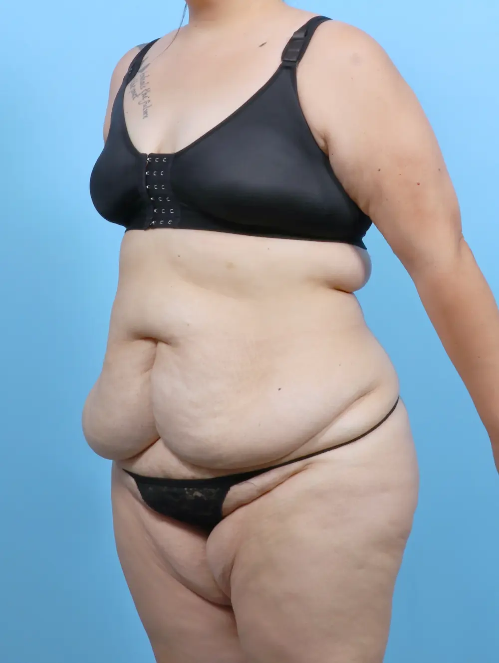 Tummy Tuck Patient Photo - Case 52493 - before view-1