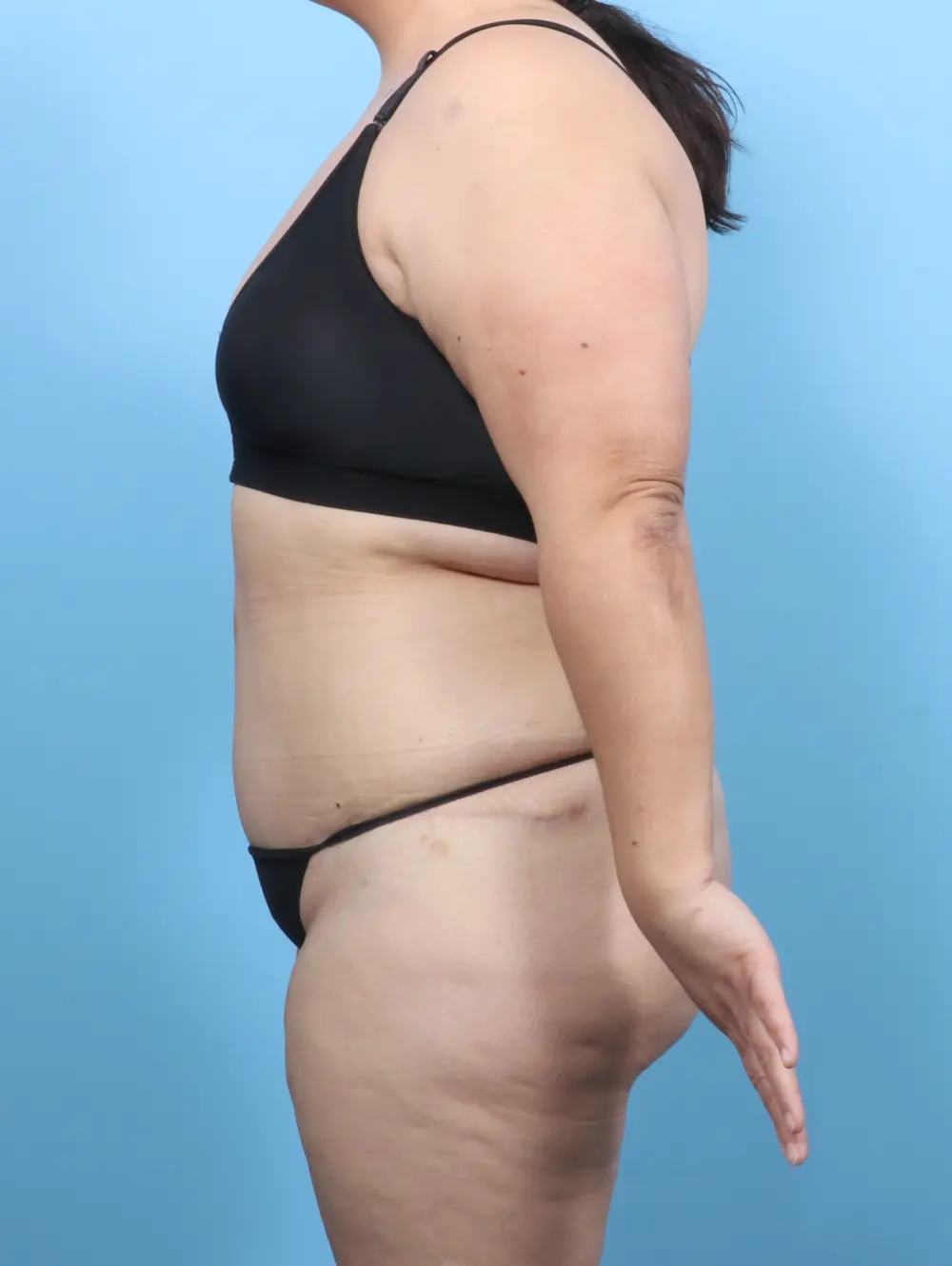 Tummy Tuck Patient Photo - Case 52493 - after view-2