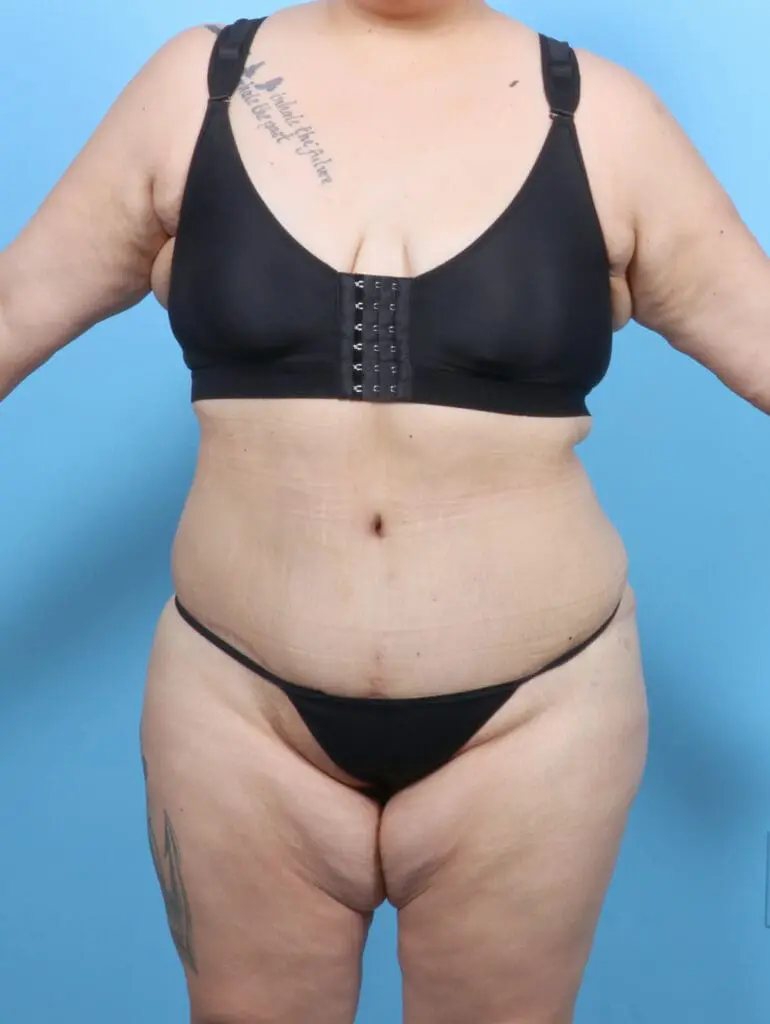 Tummy Tuck - Case 52493 - After