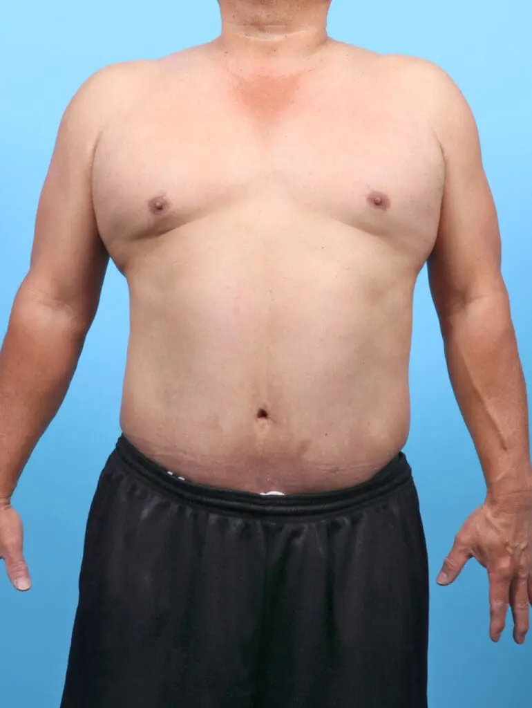 Male Tummy Tuck - Case 52515 - After