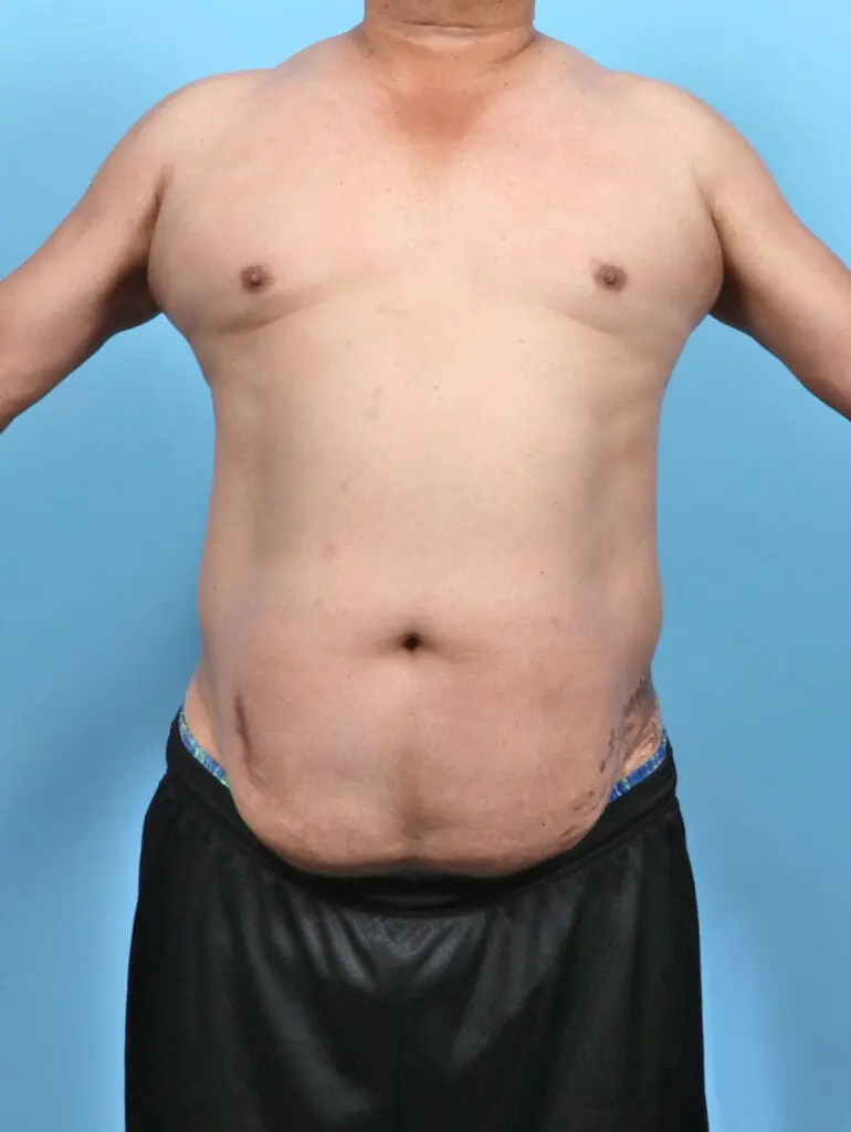 Male Tummy Tuck - Case 52515 - Before