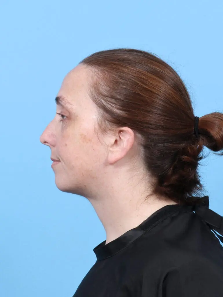 Anterior Neck Lift - Case 52541 - After