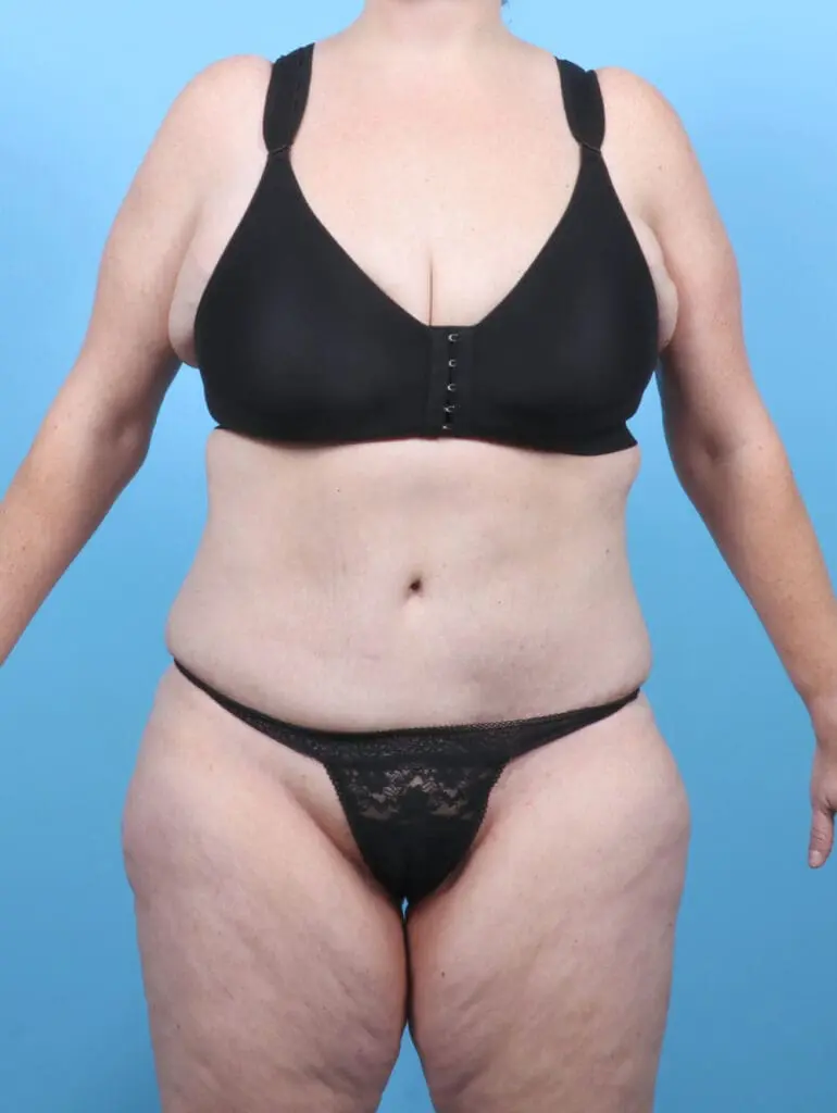 Tummy Tuck - Case 52543 - After