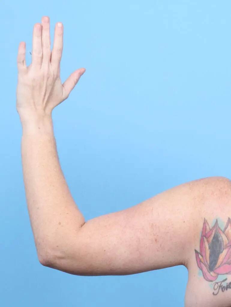 Arm Lift - Case 52523 - After