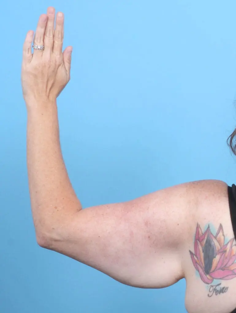 Arm Lift - Case 52523 - Before