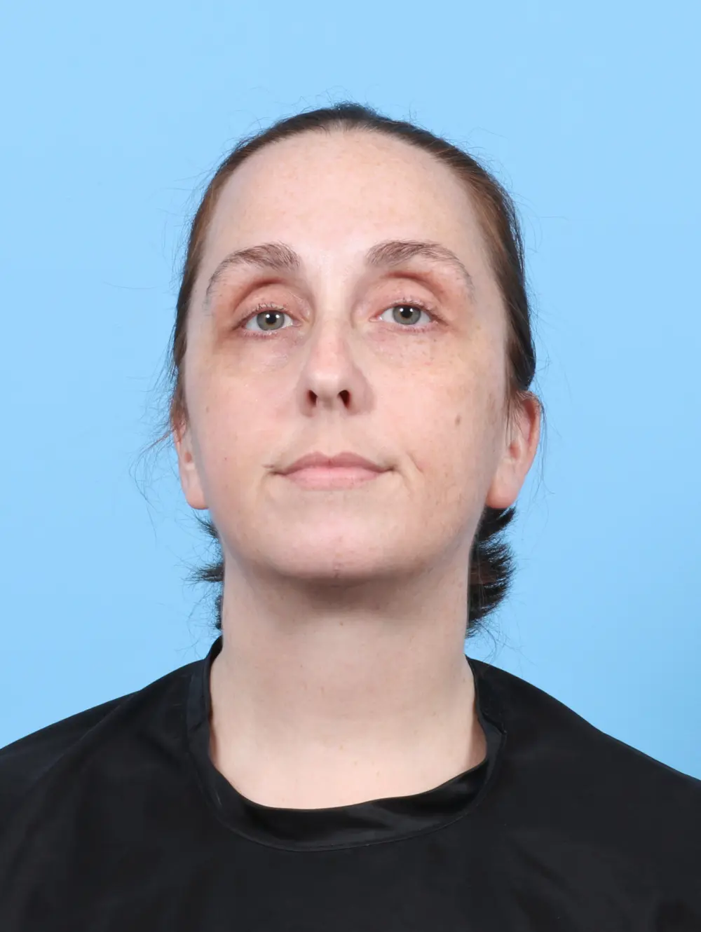 Anterior Neck Lift Patient Photo - Case 52541 - after view-2