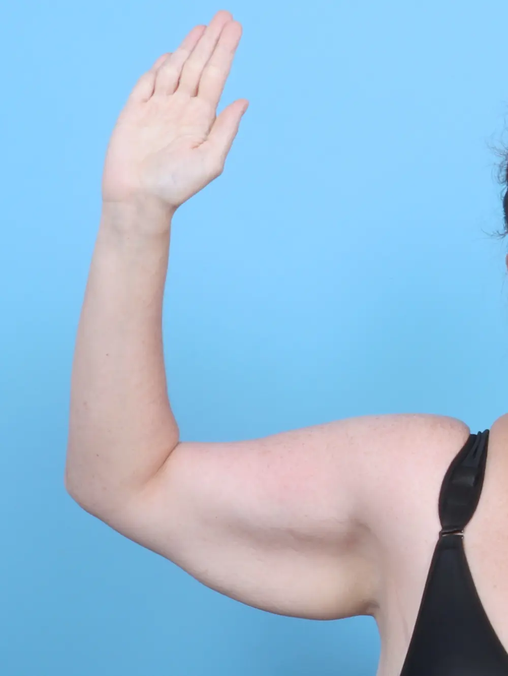 Arm Lift Patient Photo - Case 52523 - before view-1