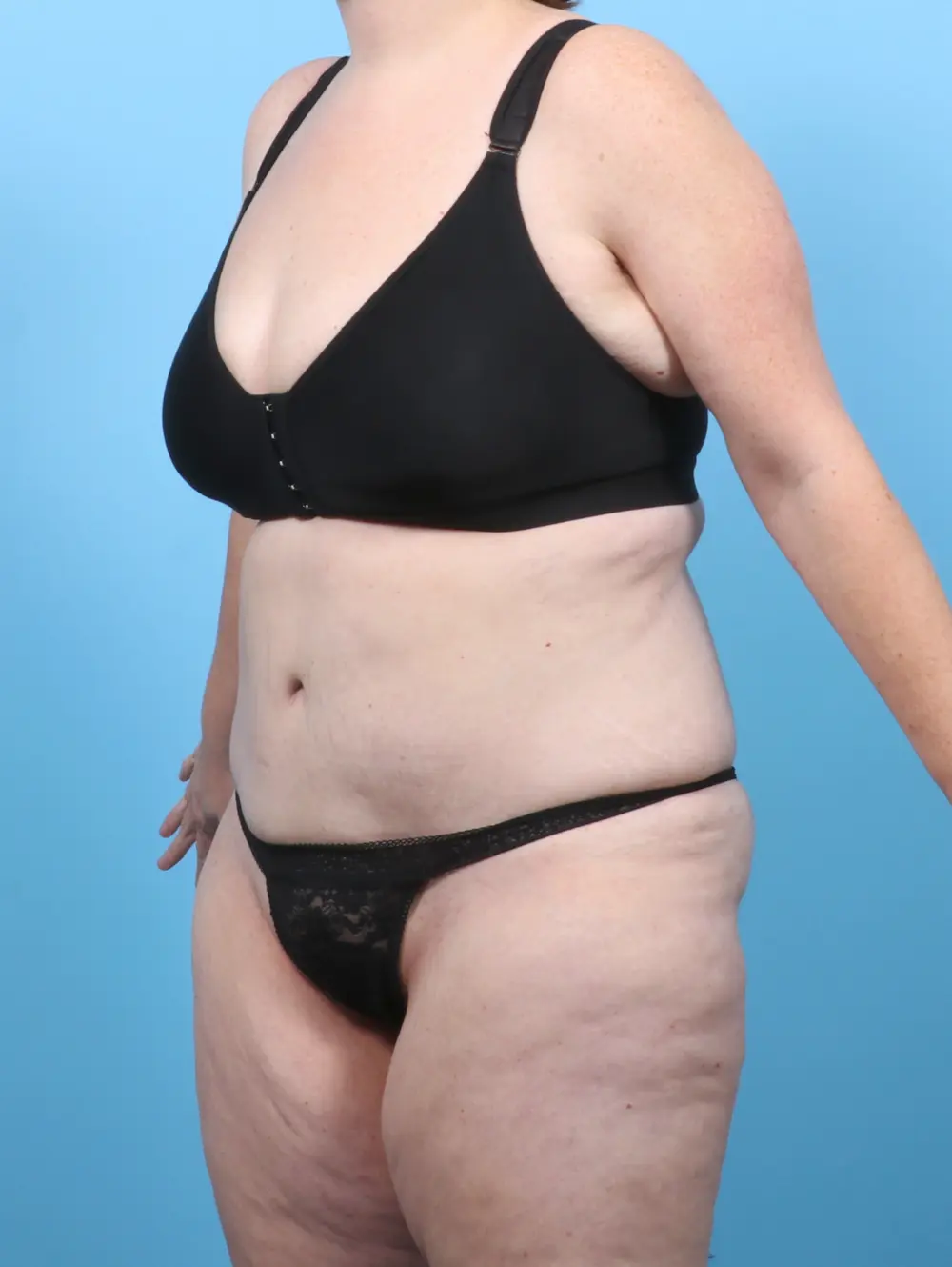 Tummy Tuck Patient Photo - Case 52543 - after view-1