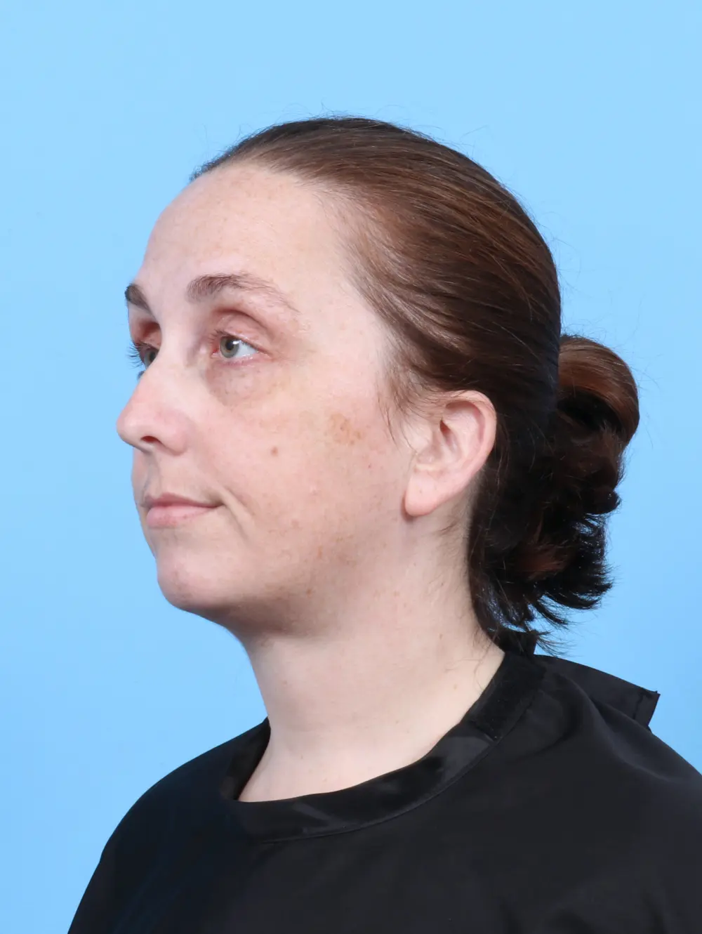 Anterior Neck Lift Patient Photo - Case 52541 - after view-1