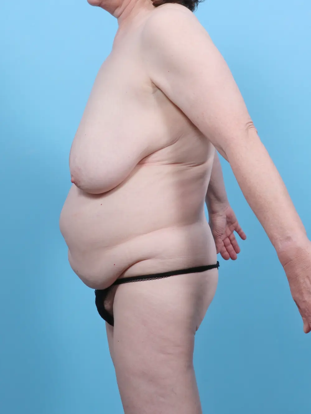 Breast Lift/Reduction w/o Implants Patient Photo - Case 52616 - before view-2