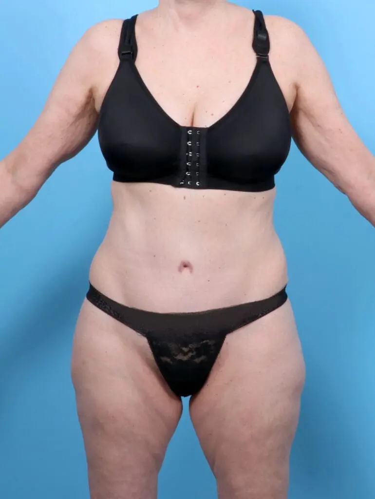 Tummy Tuck - Case 52624 - After