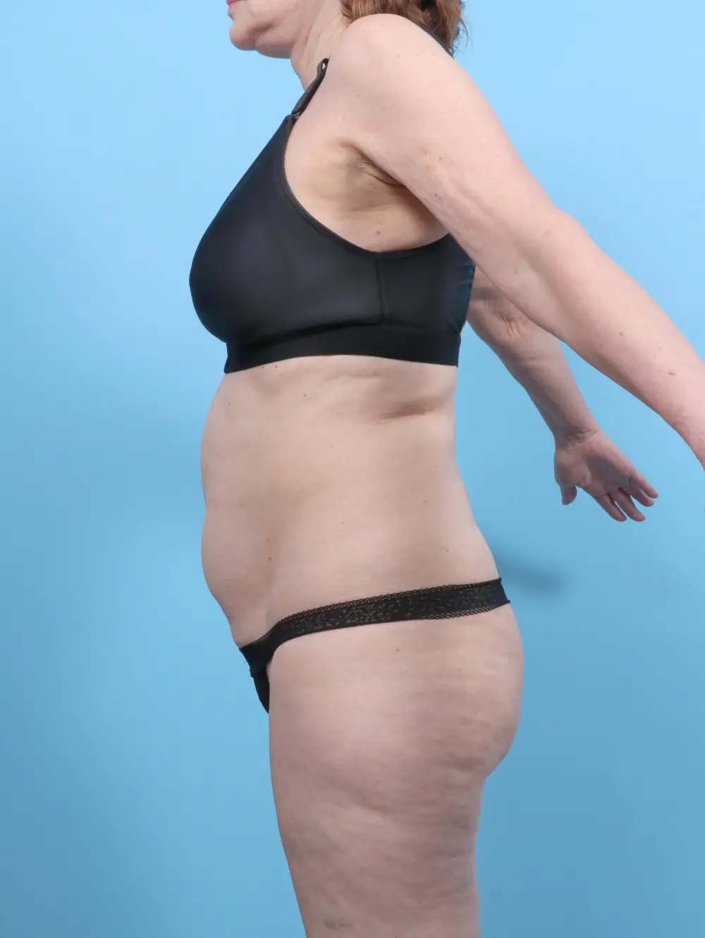 Tummy Tuck Patient Photo - Case 52624 - before view-2