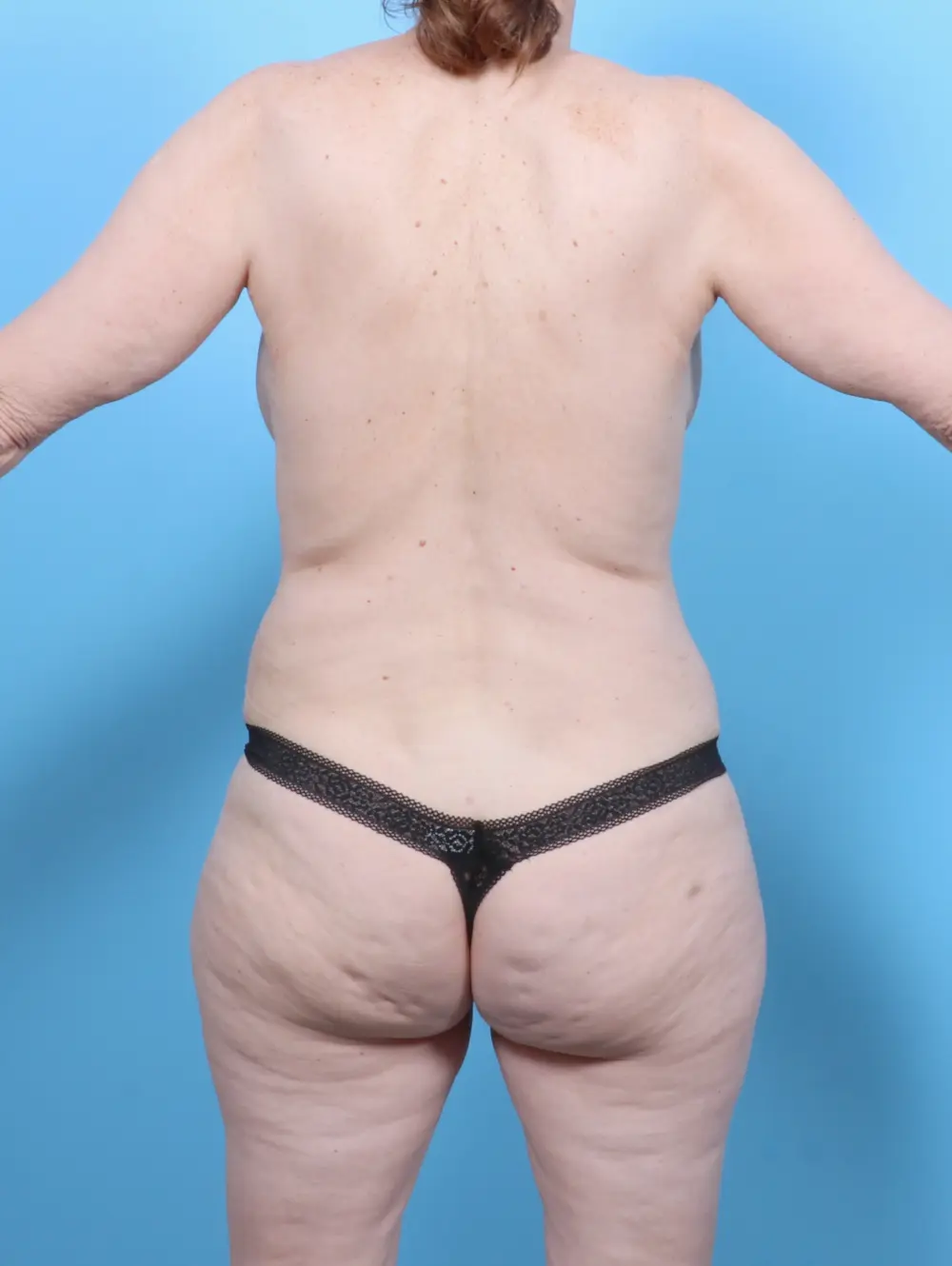 Tummy Tuck Patient Photo - Case 52624 - after view-3