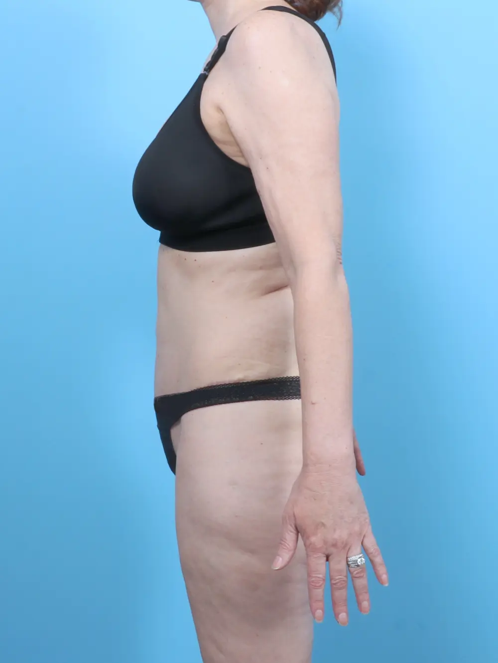 Tummy Tuck Patient Photo - Case 52624 - after view-2