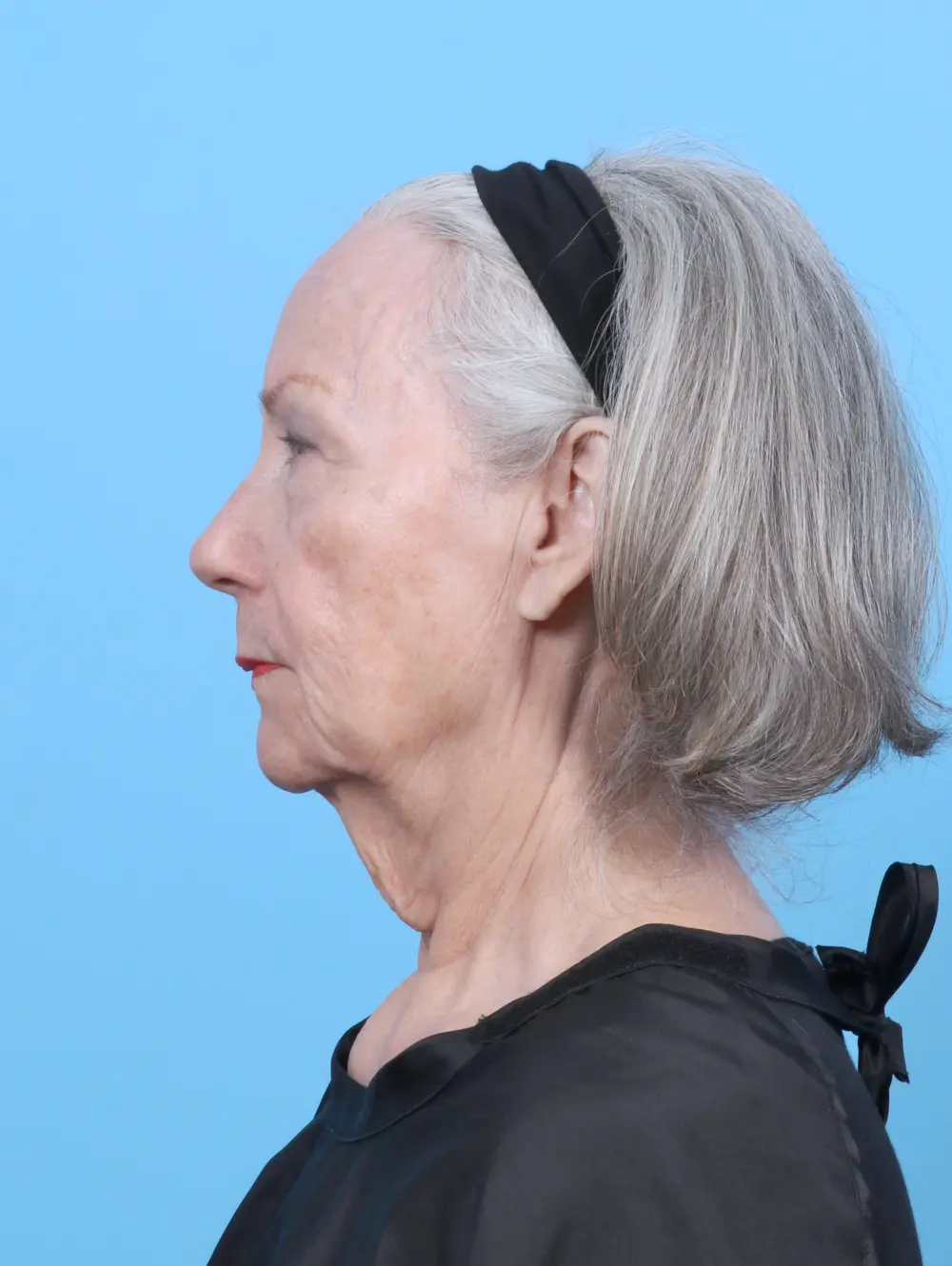 Eyelid Surgery Patient Photo - Case 52676 - before view-2