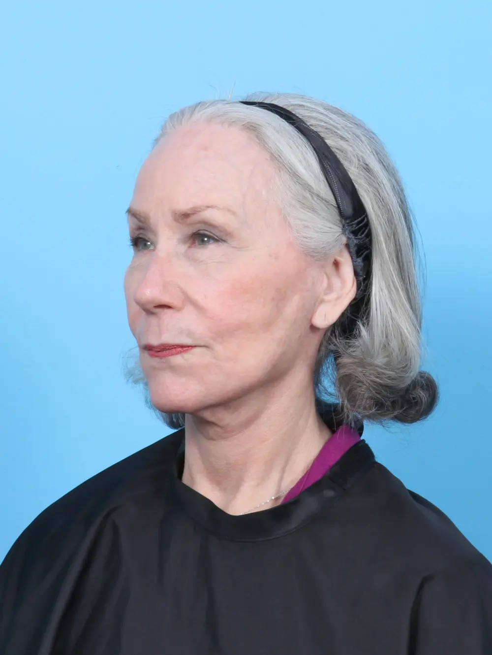 Eyelid Surgery Patient Photo - Case 52676 - after view-1