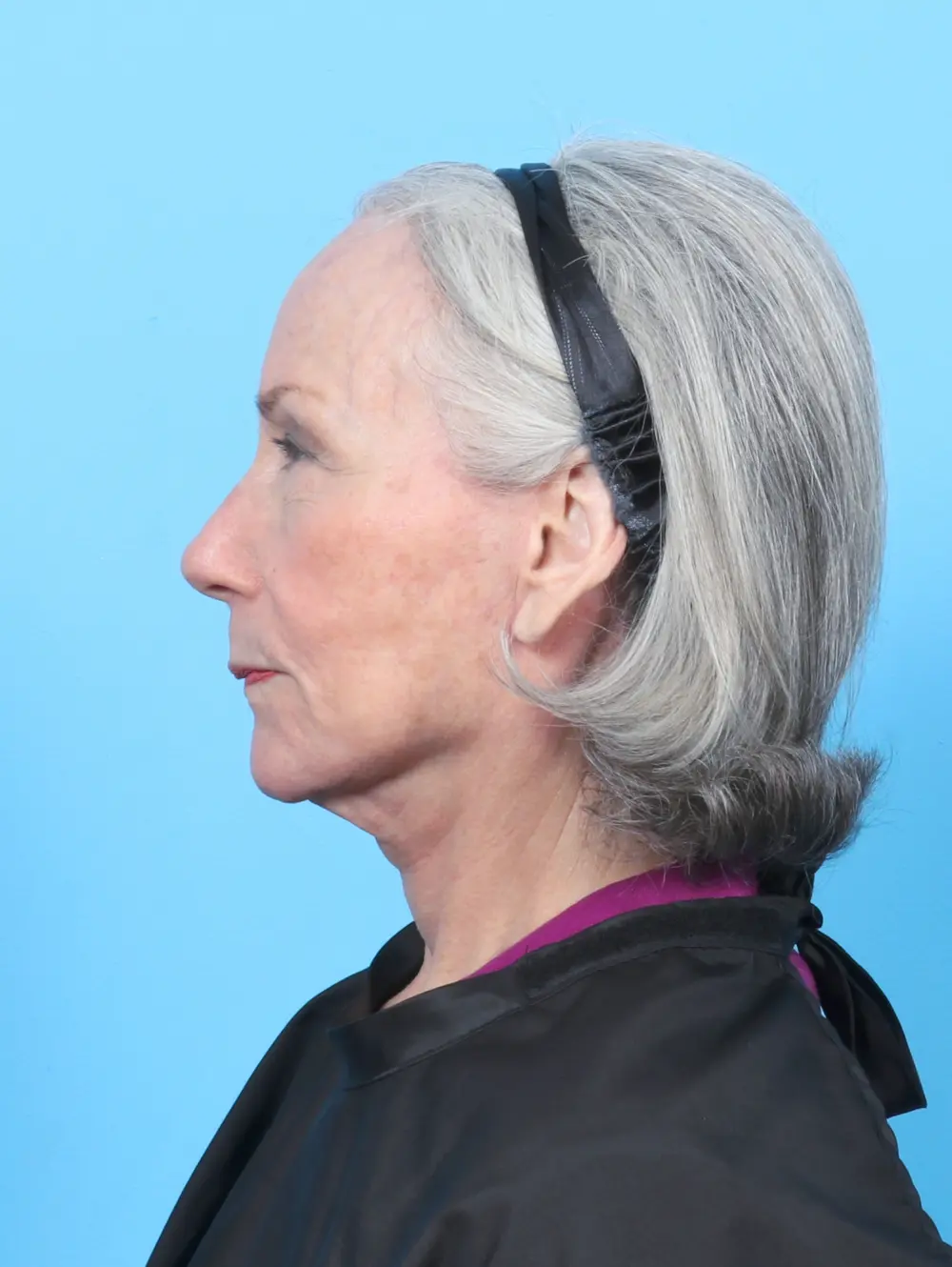 Eyelid Surgery Patient Photo - Case 52676 - after view-2