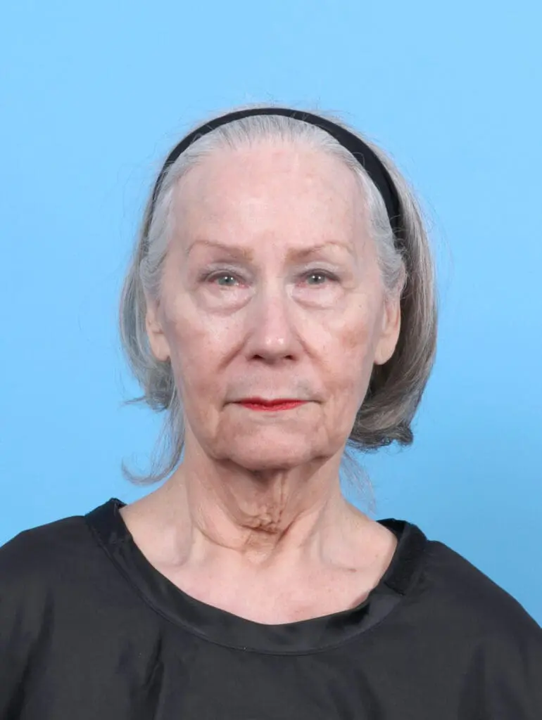 Eyelid Surgery - Case 52676 - Before