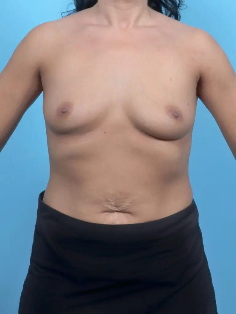 Breast Augmentation - Case 52716 - Before