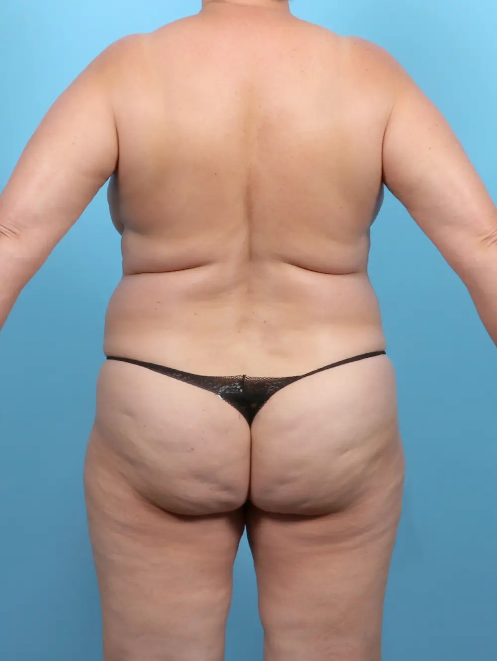 Breast Lift/Reduction w/o Implants Patient Photo - Case 52725 - before view-3