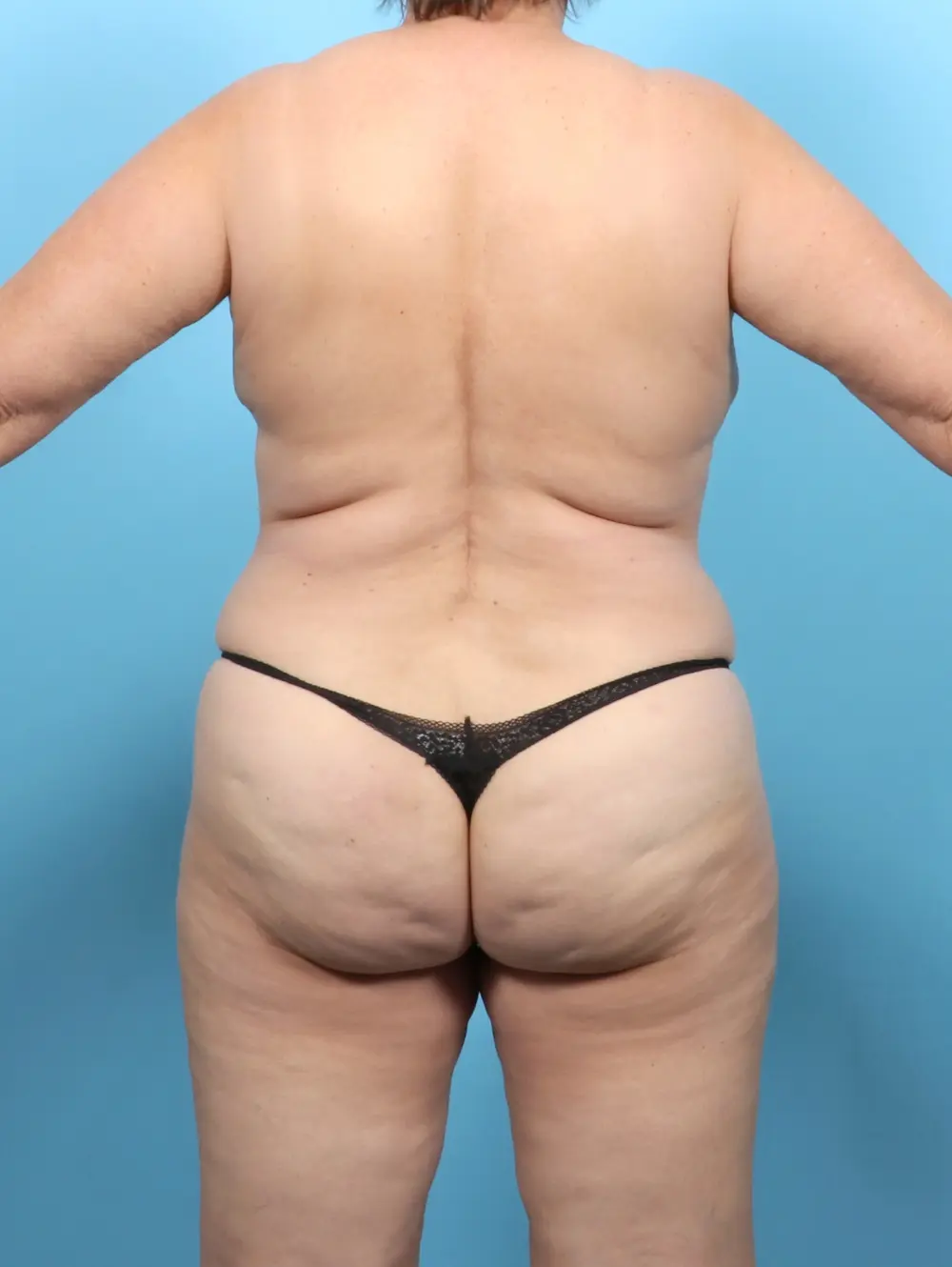 Breast Lift/Reduction w/o Implants Patient Photo - Case 52725 - after view-3