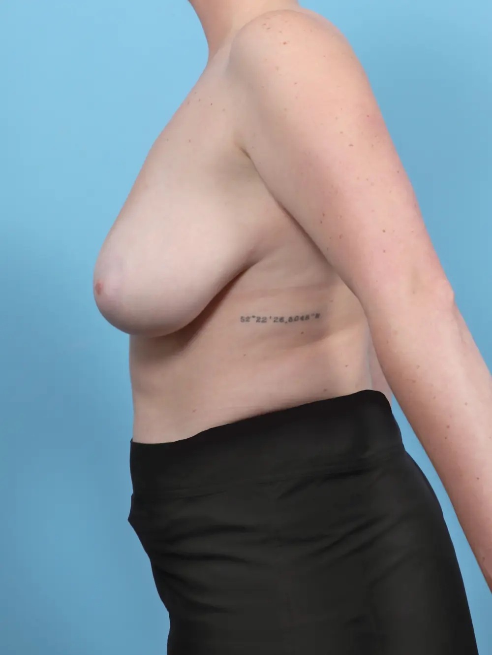 Breast Lift/Reduction with Implants Patient Photo - Case 52735 - before view-2