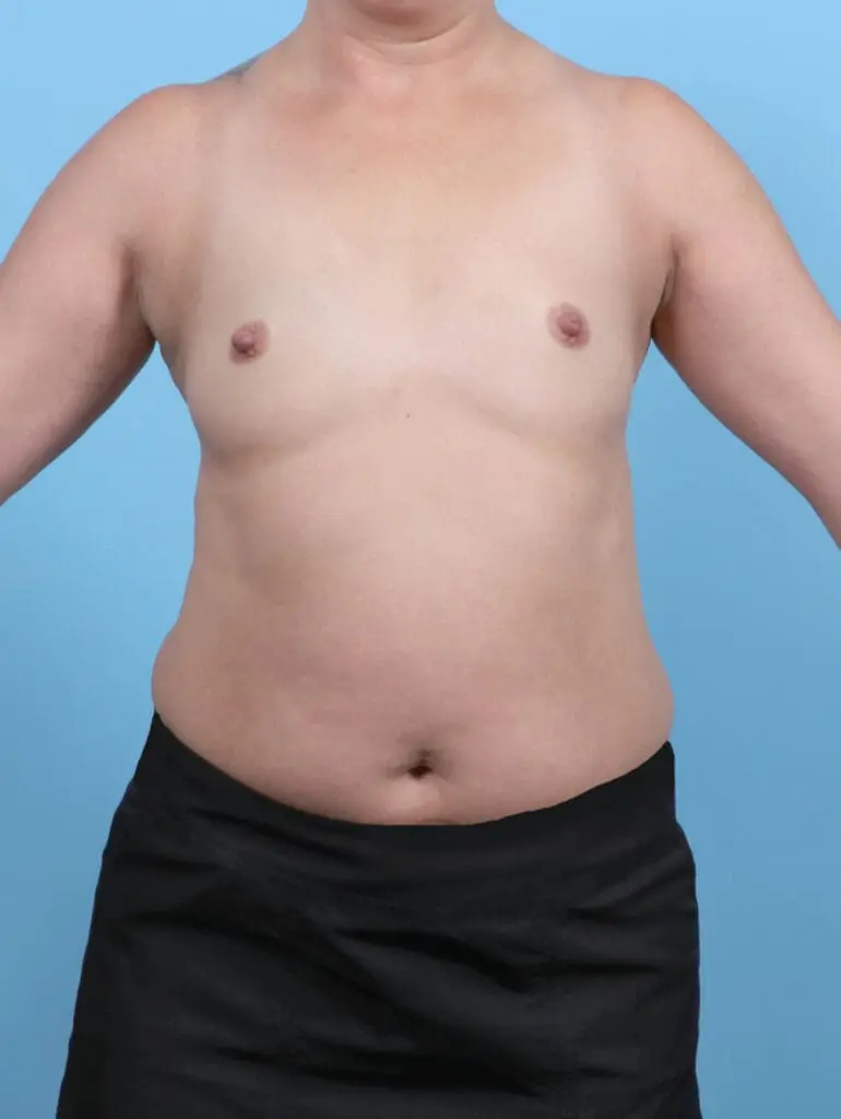 Breast Augmentation - Case 52744 - Before